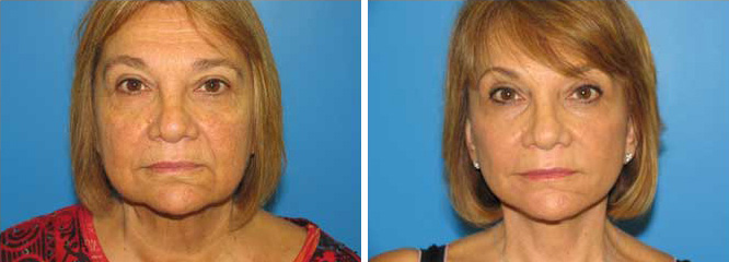 Facelift Before & After client 1