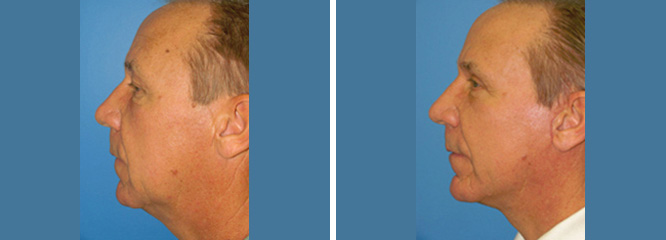 Facelift Before & After client 2