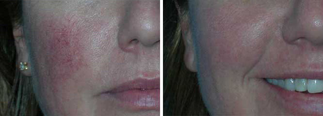 Rosacea before & after client 1